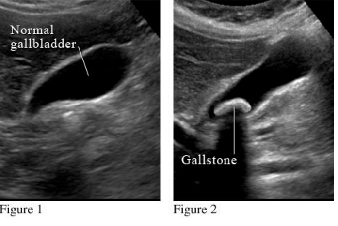 Where are my Gallstones?