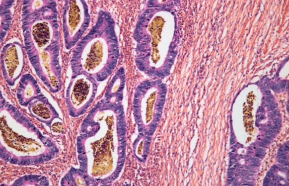 What’s the Fuss about Colorectal Cancer Screening in Hong Kong?